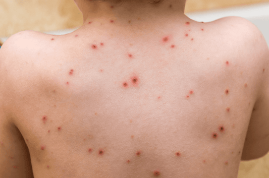 Can Red Light Therapy Treat Herpes Zoster (A.K.A. Shingles)? - Kineon