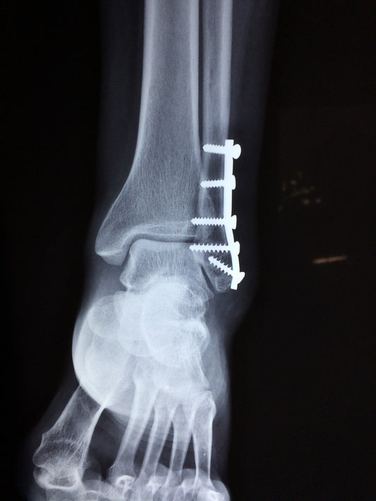 What Is The Fastest Way To Recover From Ankle Surgery? - Kineon